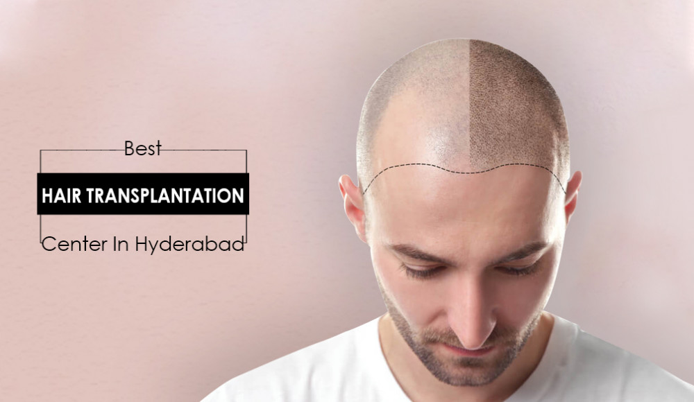 Best hair transplant center in Hyderabad