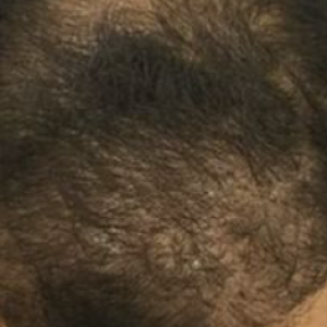 HAIR Transplatation treatment1