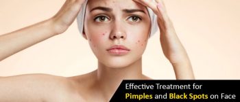 Treatment-for-Pimples-and-Black-Spots_1571734507_1000X580_c_c_0_0
