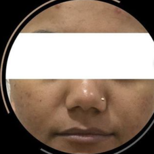 acne scaar rivision11