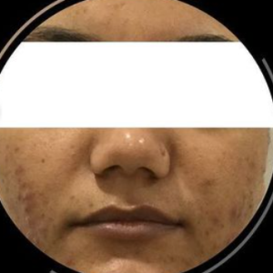 acne scar rivision1
