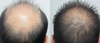 before-after-hair-transplant-results-male-patient_100209-9295
