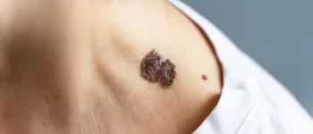 Moles Removal Treatment in Hyderabad