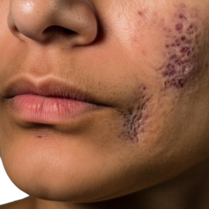 close-up-woman-with-acne-her-face_893012-130538-removebg-preview