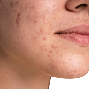 confident-young-woman-with-acne-close-up_23-2148982535-removebg-preview