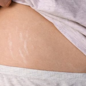 female-body-with-stretch-marks-closeup-problematic-skin-girl-with-changes-after-childbirth_340805-712