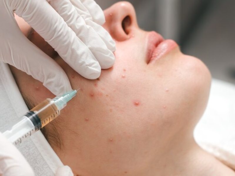 fpdl.in_young-woman-cosmetology-clinic-undergoing-acne-treatment-with-injections-effective-remedy_168410-1393_normal.jpg
