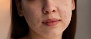 [freepicdownloader.com]-person-dealing-with-rosacea-large