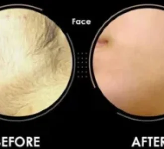 laser-hair-removal-300x173