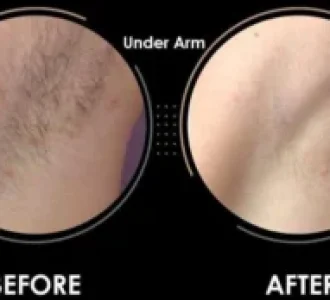 laser-hair-removal1-300x174