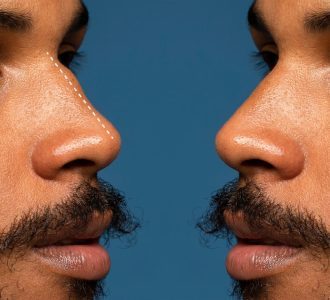 man-before-after-rhinoplasty-side-view_23-2149947587.jpg