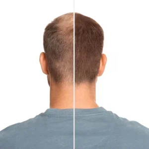 man-with-hair-loss-problem-before-after-treatment-white-background-collage-visiting-trichologist_495423-43062
