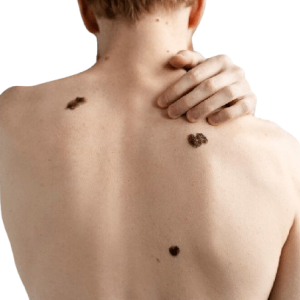 young-man-with-melanoma-back-view_23-2149359612-removebg-preview